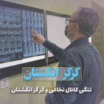 تنگی کانال نخاعی و گز گز انگشتان | دکتر مرندی