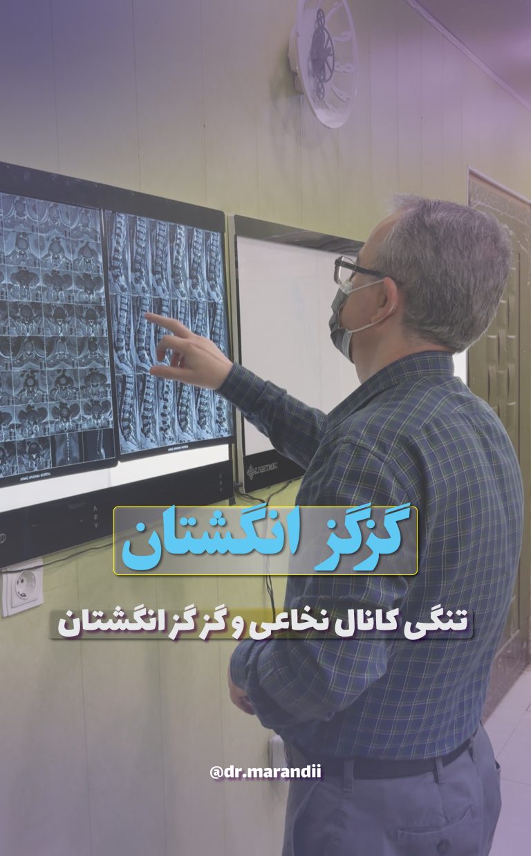 تنگی کانال نخاعی و گز گز انگشتان | دکتر مرندی